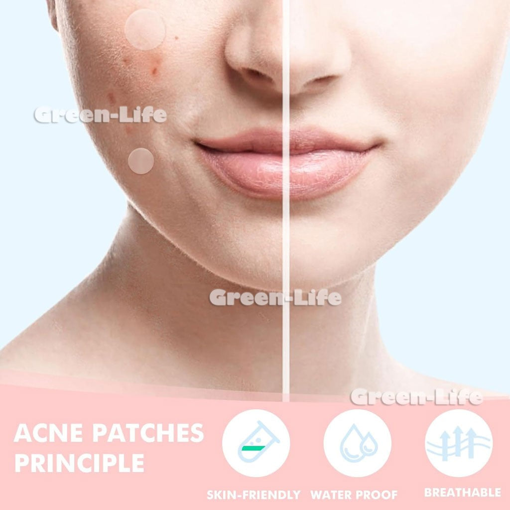 200 Pieces Acne Patch Tag Hydrocolloid Pimple Spot Acne Patch Plaster Pimple