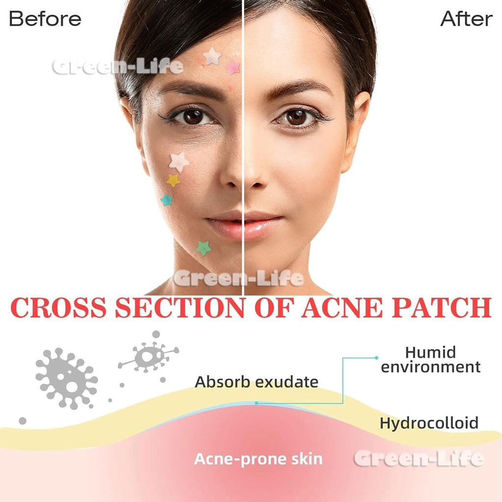 200 Pieces Acne Patch Tag Hydrocolloid Pimple Spot Acne Patch Plaster Pimple